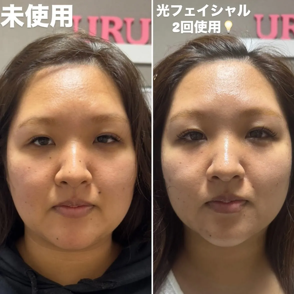 光フェイシャルの効果です︎💕︎💡左がbeforeです✨