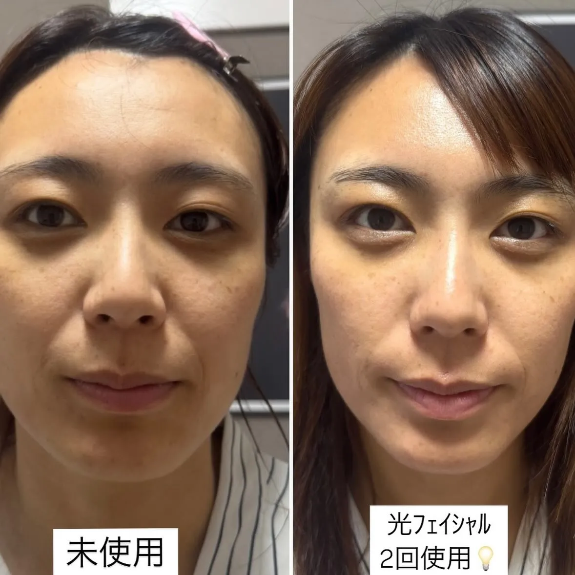 光フェイシャルの効果です︎💕︎💡左がbeforeです✨