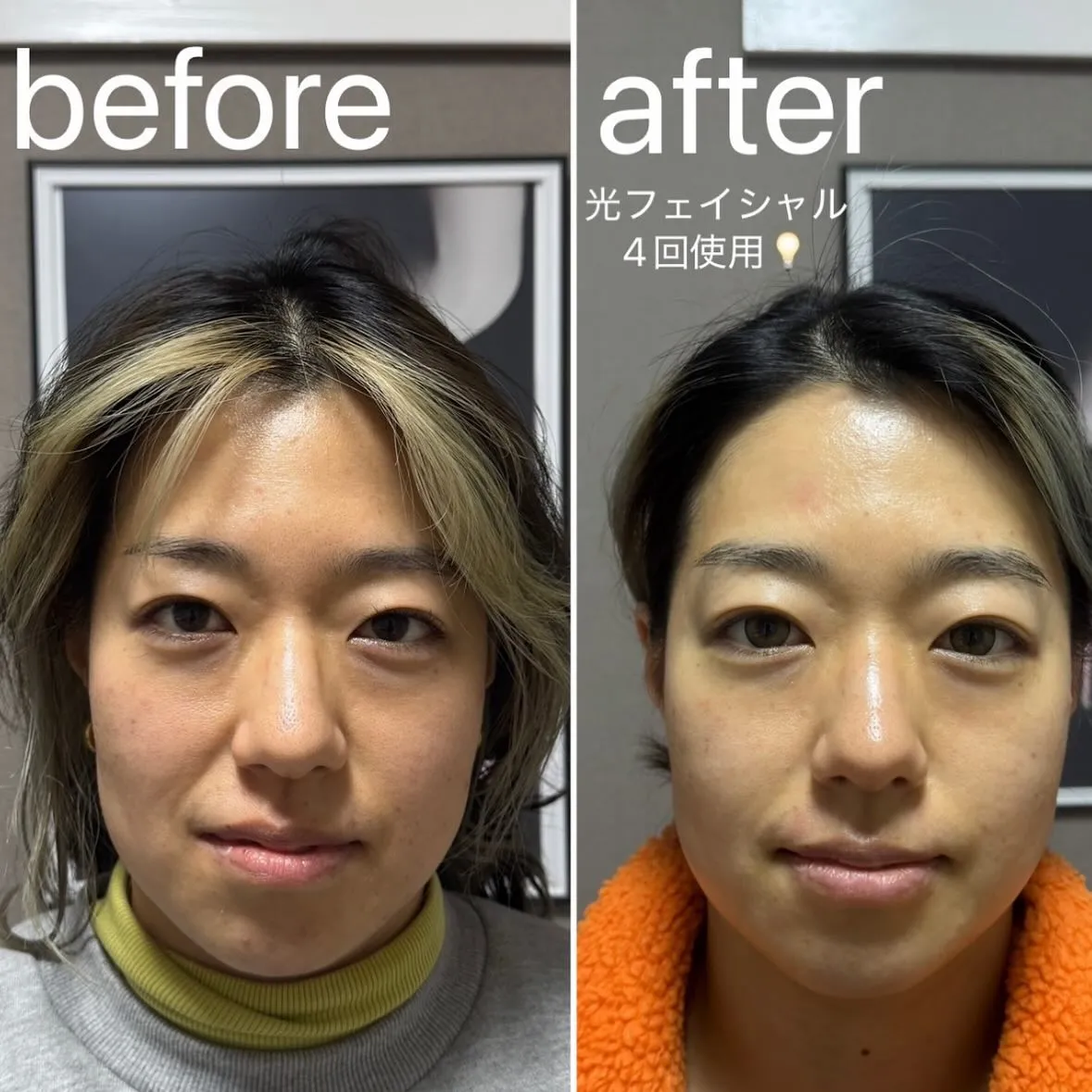 光フェイシャルの効果です︎💕︎💡左がbeforeです✨