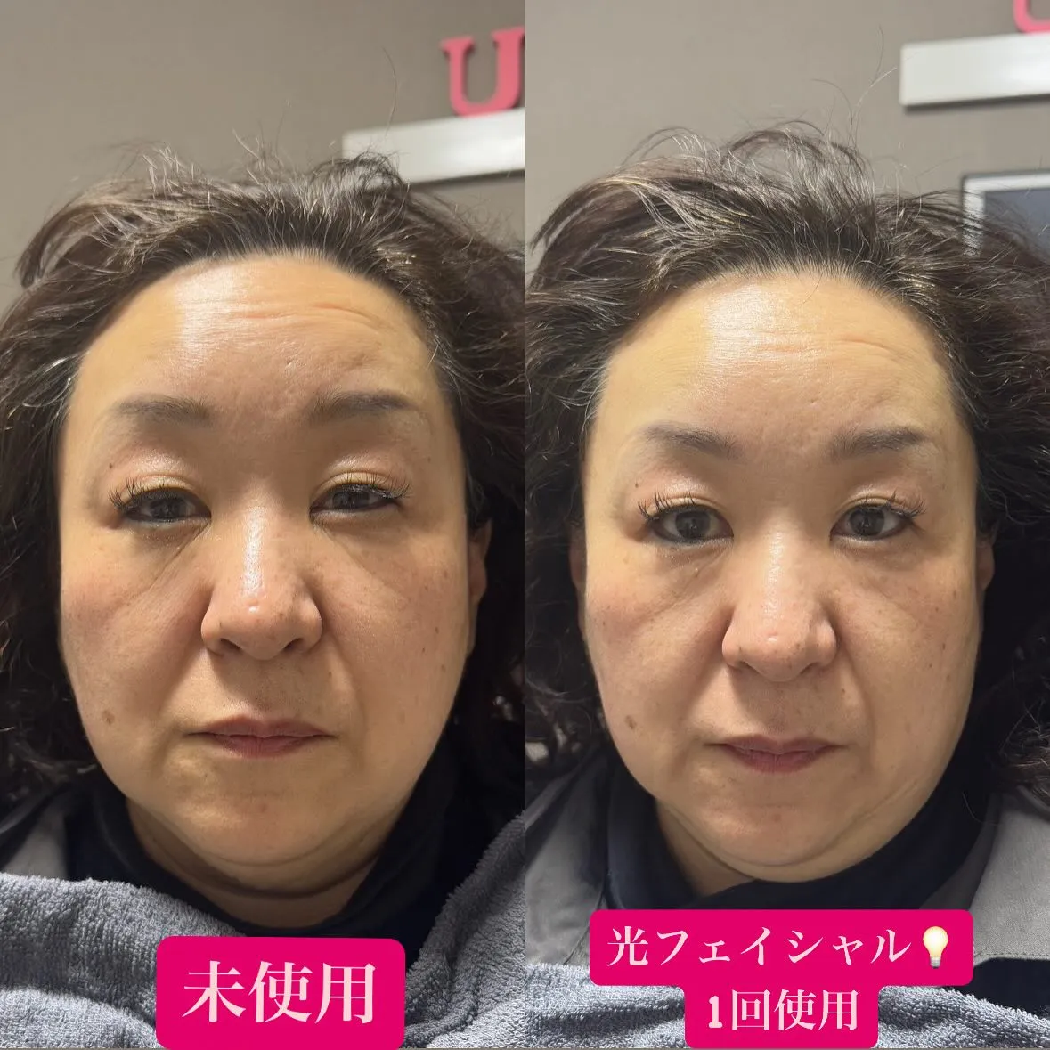 光フェイシャルの効果です︎💕︎💡左がbeforeです✨
