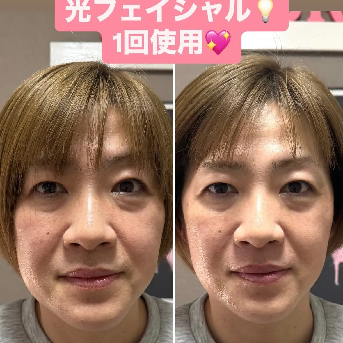 光フェイシャルの効果です︎💕︎💡左がbeforeです✨