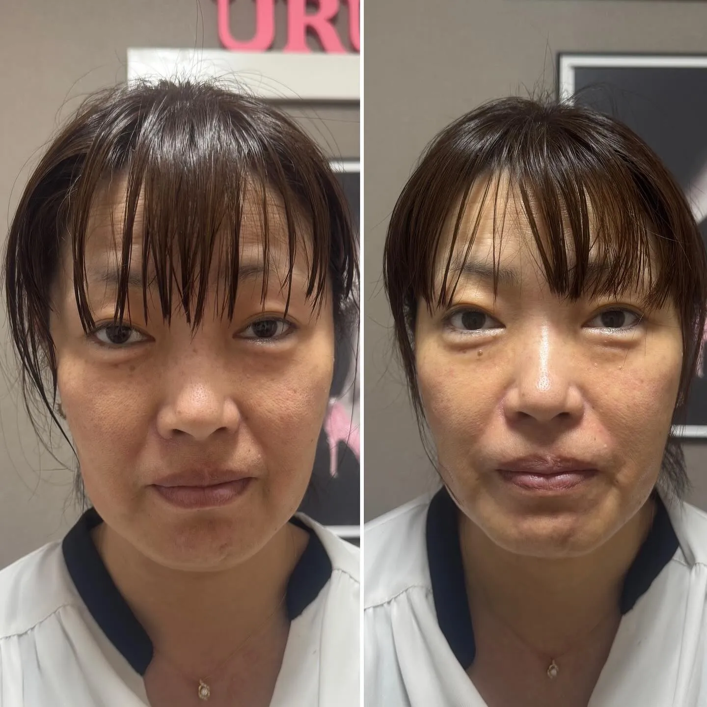 光フェイシャルの効果です︎💕︎💡左がbeforeです✨