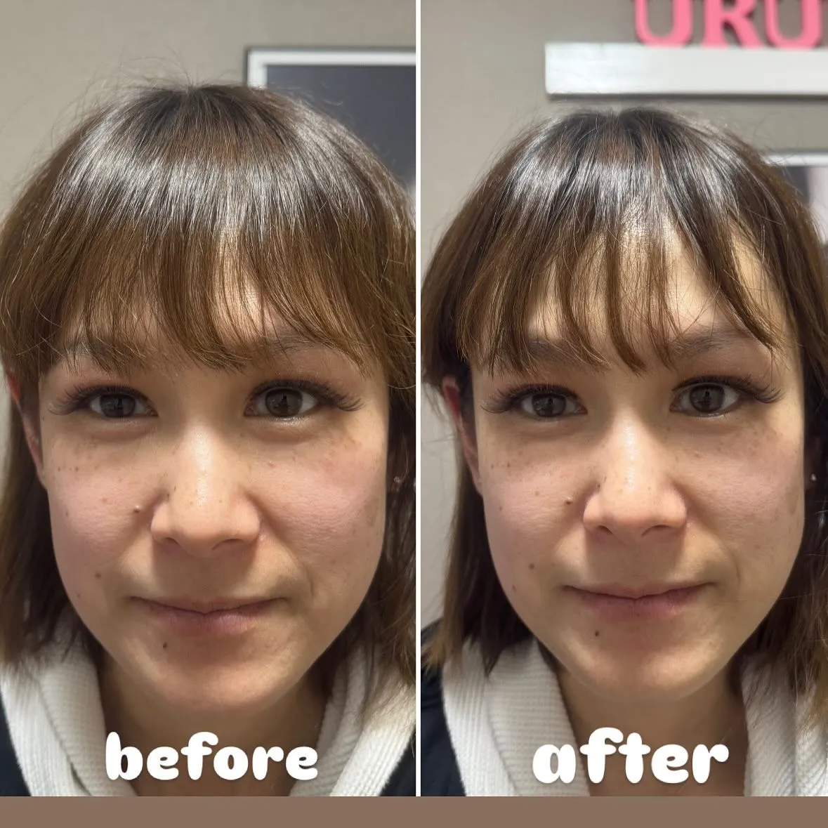 光フェイシャルの効果です︎💕︎💡左がbeforeです✨